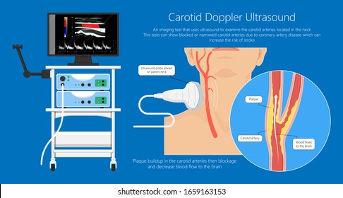 Coronary Artery Disease CAD Diagnosis Carotid Duplex Doppler Ultrasound Study Treat Endarterectomy Transient Ischemic Attack Test TIA Blocked Blood Flow Neck Stent