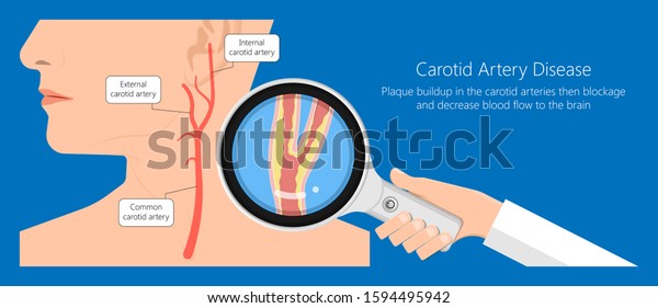 Coronary artery disease CAD\
diagnosis carotid duplex doppler ultrasound study treat\
Endarterectomy transient ischemic attack test TIA blocked blood\
flow neck stent
