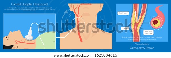Coronary artery disease CAD\
diagnosis carotid duplex doppler ultrasound study treat\
Endarterectomy transient ischemic attack test TIA blocked blood\
flow neck stent