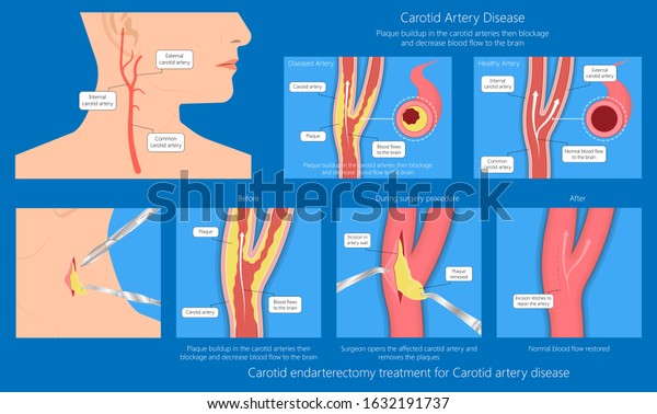 Каротидная эндартерэктомия это. Каротидная эндартерэктомия головного мозга. Эндартерэктомия осложнения. Каротидная эндартерэктомия сонной артерии осложнения. Каротидная эндартерэктомия сонной артерии ход операции.