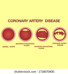  Coronary artery disease concept. Healthy and narrowed arteries with plaques. The accumulation of cholesterol in the blood vessels. Illustration isolated on white background. Atherosclerosis of blood 