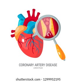 Coronary artery disease concept. Human heart and zoomed artery with plaque. Medical vector illustration in flat style