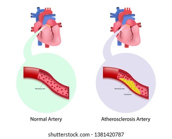 Coronary Artery Disease Human Cholesterol Artery Stock Vector (Royalty ...