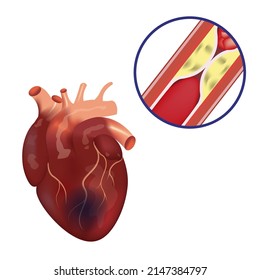 81 Myocardial Necrosis Images, Stock Photos & Vectors | Shutterstock