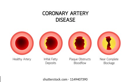 Coronary Artery Disease Infographic. Heart Awareness Concept. Atherosclerosis Stages In Artery Caused By Cholesterol Plaque. Vector Illustration Isolated On White Background.