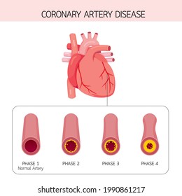 Coronary Artery Disease Narrowing Or Blockage Of Coronary Arteries, Condition Caused By Build-up Of Cholesterol And Fatty Inside Arteries