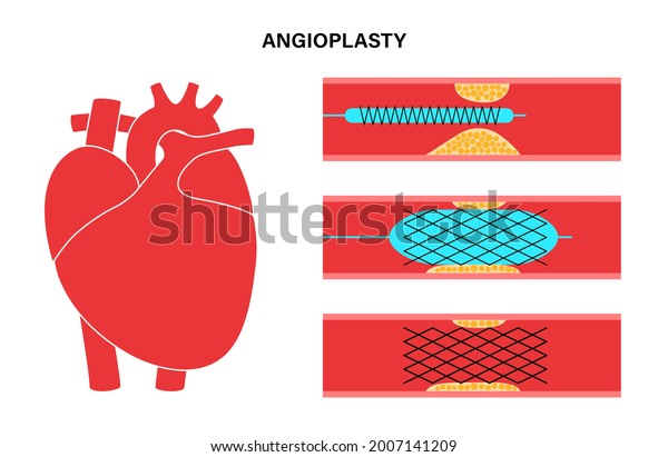Coronary artery stent in ischaemic heart\
muscle. Angioplasty technology. IHD treatment. Cardiovascular\
disease procedure. Blocked vascular, embolism, infarction and\
thrombosis flat vector\
illustration