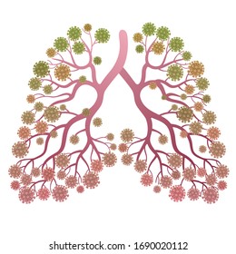 Coronavirus 2019-nCoV in human lungs vector illustration. Pneumonia. 