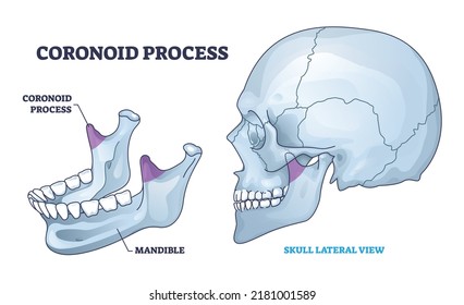 Coronoid process anatomy with isolated bone and skull view outline diagram. Labeled educational scheme with mandible as chin medical skeleton vector illustration. Anatomical physiology description.