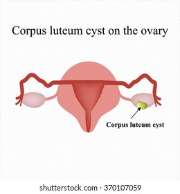 Corpus Luteum Cyst On Ovary Functional Stock Vector (Royalty Free ...