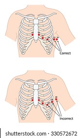 Correct And Incorrect Lead Placement For Ecg Ekg Readings, Based On The Locations Of Ribs, Sternum And Axilla.