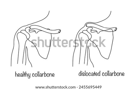 Correct and incorrect position of the collarbone in the body. Dislocated collarbone. Deviation from the normal position of the bone in the sternal segment. Medical vector illustration.