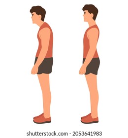 Correct and incorrect standing posture.Cervical spinal curvature. Hump. Healthy back.Vector illustration on white background. 