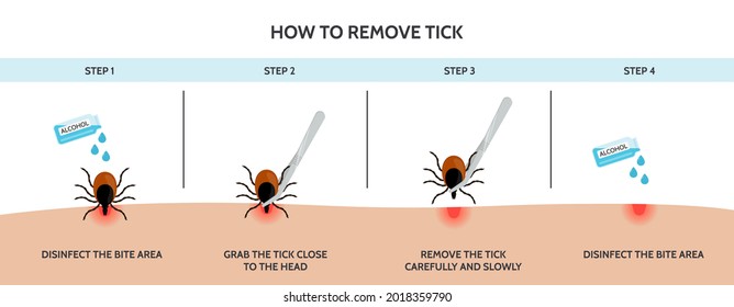 The correct way to remove a tick insect correctly. A mite parasite carrying a disease - borreliosis, encephalitis and Lyme disease