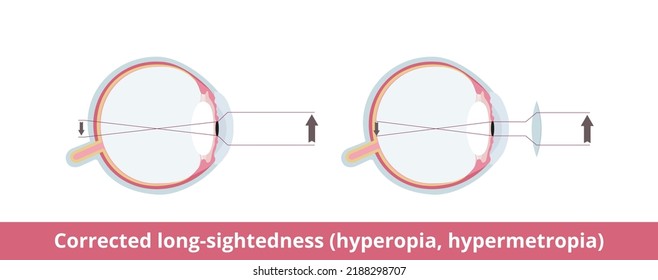 Corrected long-sightedness (hyperopia, hypermetropia). Eye condition affects the ability to see nearby objects, they are out of focus. May be corrected with glasses or contact lenses.