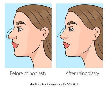 Correction of crooked nose with rhinoplasty schematic vector illustration. Medical science educational illustration