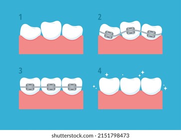 Correction of crooked teeth, a set of vector flat illustrations. Beautiful correction teeth. Teeth before and after. Healthy, straight teeth after treatment and correction