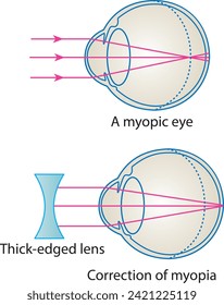 corrección de hipermetro, ojo, visión de futuro, visión de futuro, estructura ocular, biología, visual, ojo hiperópico, miopía, hiperopía
