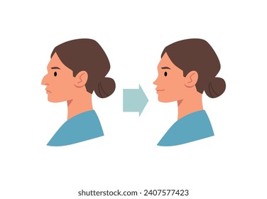 Correction plastic surgery, nose reshaping. Before After rhinoplasty. Woman with a big crooked nose and happy lady beautiful little nose. Facial reduction vector infographic illustration