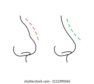Correction of profile of nose line, changing nasal shape during rhinoplasty surgery. Hump nose and straight nose. Vector illustration 