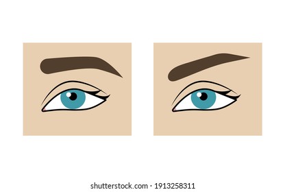 Correction Of Shape Of  Eyebrows Before And After. Eyebrow Lift With Threads, Plastic Surgery, Comparison. Vector Illustration