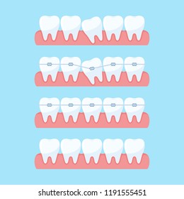 Correction of teeth with orthodontic braces. Stages of teeth alignment, before and after correction with brackets. Dental clinic services. Vector illustration in flat style