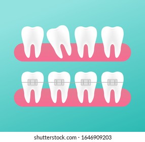 Correction of teeth with orthodontic braces. Stages of teeth alignment. Dental clinic services. Vector illustration.