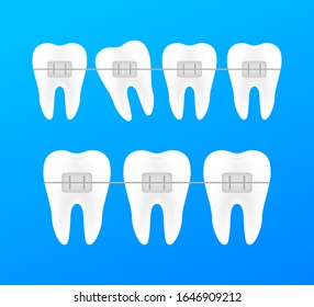 Correction of teeth with orthodontic braces. Stages of teeth alignment. Dental clinic services. Vector illustration.