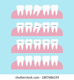 Correction of teeth with orthodontic braces. Tooth orthodontic treatment vector illustration. Before and after dental braces tooth correction concept