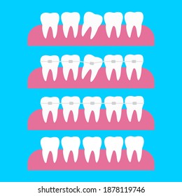 Correction of teeth with orthodontic braces. Tooth orthodontic treatment vector illustration. Before and after dental braces tooth correction concept