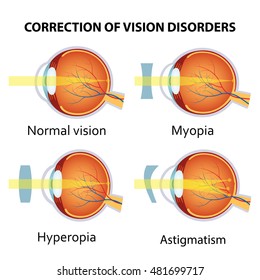a szem myopia és hyperopia képe