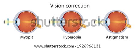 Correction of various eye vision disorders by lens. Hyperopia, myopia, astigmatism. Vector illustration