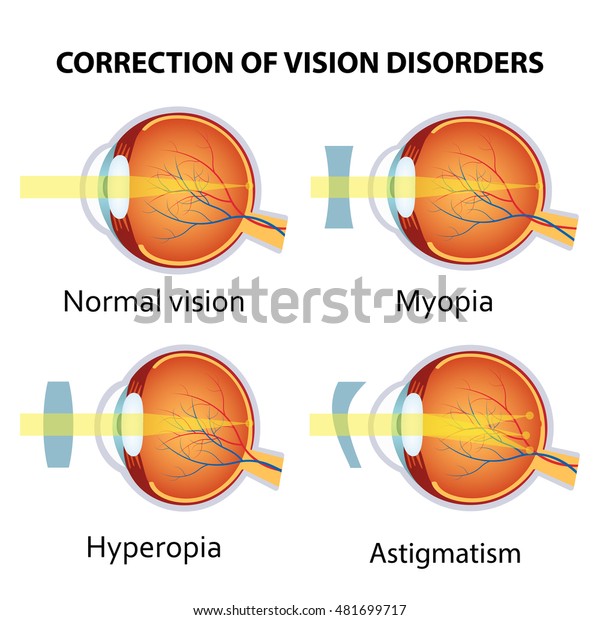 Astigmatism: ce este? Cum să tratați astigmatismul ocular acasă?