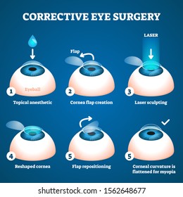 Corrective eye surgery vector illustration. Laser process education scheme. Sight improvement with LASIK technology. Procedure process stages visualization with cornea flap creating and sculpting.