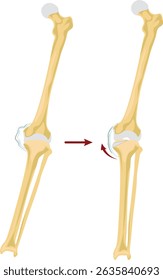 A osteotomia corretiva é um procedimento cirúrgico que envolve cortar e realinhar os ossos para corrigir deformidades, melhorar a função ou aliviar a dor causada por doenças como artrite, maluniões etc