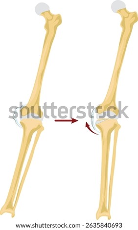 Corrective osteotomy is a surgical procedure that involves cutting and realigning bones to correct deformities, improve function, or relieve pain caused by conditions such as arthritis, malunions etc