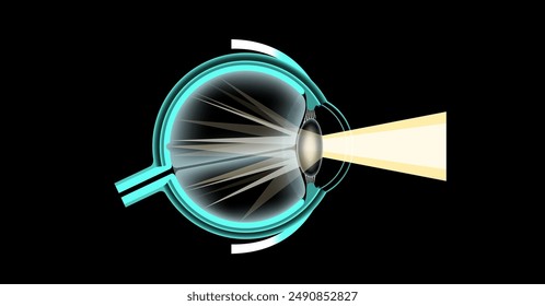 Cortical cataract disease, eye and pupil anatomy. Lens clouding, vision impairment, and potential blindness. Vision problems during aging. Human vision loss concept. Blindness 3D vector illustration