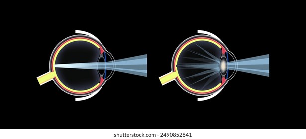 Cortical cataract disease, eye and pupil anatomy. Lens clouding, vision impairment, and potential blindness. Vision problems during aging. Human vision loss concept. Blindness 3D vector illustration