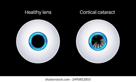 Cortical cataract disease, eye and pupil anatomy. Lens clouding, vision impairment, and potential blindness. Vision problems during aging. Human vision loss concept. Blindness 3D vector illustration