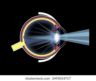 Cortical cataract disease, eye and pupil anatomy. Lens clouding, vision impairment, and potential blindness. Vision problems during aging. Human vision loss concept. Blindness 3D vector illustration