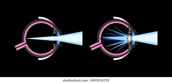 Cortical cataract disease, eye and pupil anatomy. Lens clouding, vision impairment, and potential blindness. Vision problems during aging. Human vision loss concept. Blindness 3D vector illustration