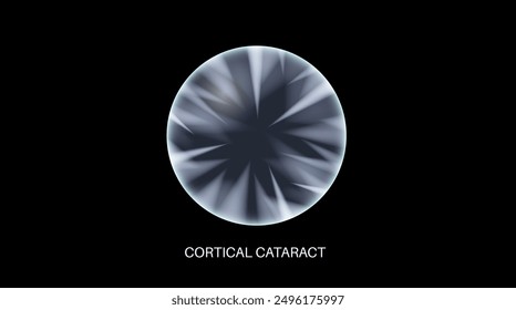 Cortical cataract disease, eye and pupil anatomy. Lens clouding, vision impairment, and potential blindness. Vision problems during aging. Human vision loss concept. Blindness 3D vector illustration