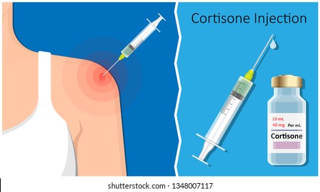 Cortisone shots injection epidural steroid ESI lumbar back spinal nerves anti inflammatory Carpal Tunnel Syndrome tennis elbow symptom swelling chronic discomfort