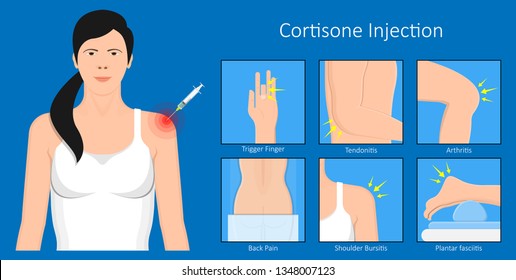 Cortisone Shots Injection Epidural Steroid ESI Lumbar Back Spinal Nerves Anti Inflammatory Carpal Tunnel Syndrome Tennis Elbow Symptom Swelling Chronic Discomfort