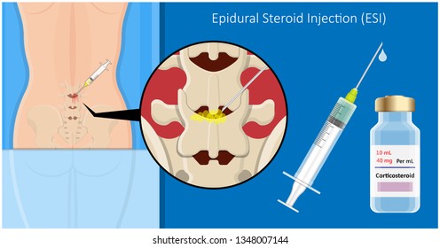 Cortisone Shots Injection Epidural Steroid ESI Lumbar Back Spinal Nerves Anti Inflammatory Carpal Tunnel Syndrome Tennis Elbow Symptom Swelling Chronic Discomfort