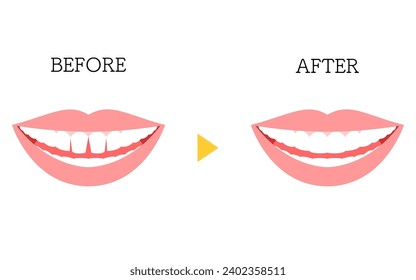 Dentista cosmética, unión directa antes y después, dientes anteriores y vectoriales atrapados, ilustración vectorial