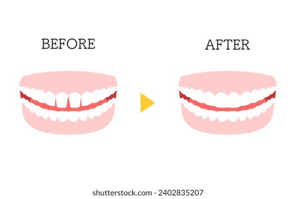 Cosmetic Dentistry, Direct Bonding Before and After, Gapped Anterior Teeth, Vector Illustration