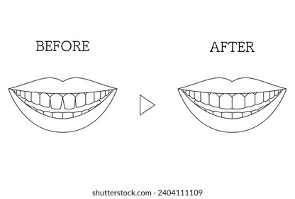 Cosmetic Dentistry, Direct Bonding Before and After, Gapped Anterior Teeth, Vector Illustration