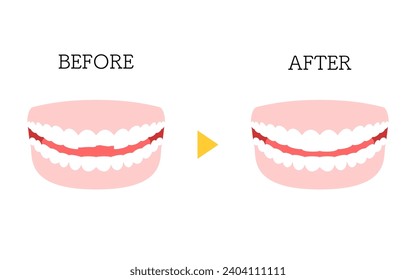 Odontología cosmética, unión directa antes y después, diente picado, Ilustración vectorial