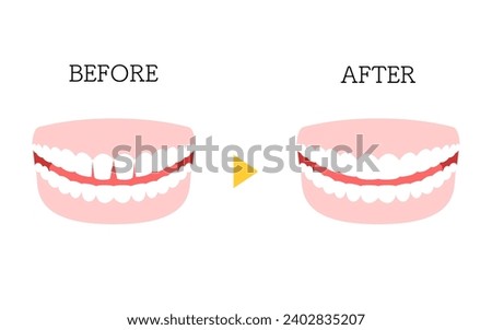 Cosmetic Dentistry, Direct Bonding Before and After, Gapped Anterior Teeth, Vector Illustration